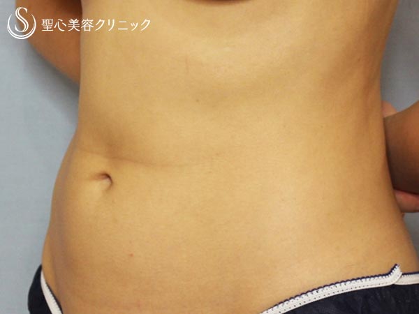 【30代女性・切らずにお腹まわりをスッキリ】リポセル（腹部痩身の機械治療、3ヶ月後） Before 
