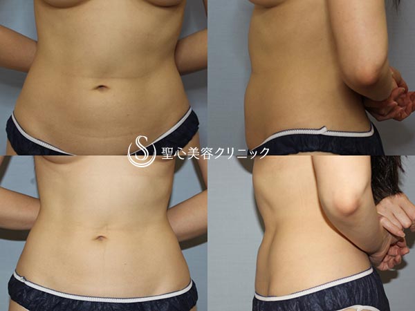 【30代女性・切らずにお腹まわりをスッキリ】リポセル（腹部痩身の機械治療、3ヶ月後） After 