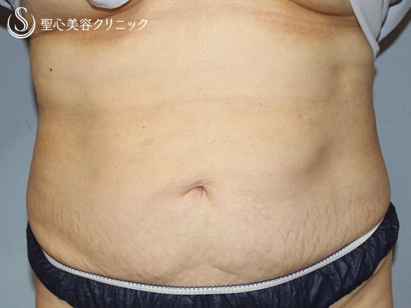 【50代女性・切らずにお腹まわりをスッキリ】リポセル（腹部痩身の機械治療、3ヶ月後） After 