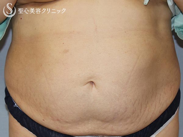 【50代女性・切らずにお腹まわりをスッキリ】リポセル（腹部痩身の機械治療、3ヶ月後） Before 