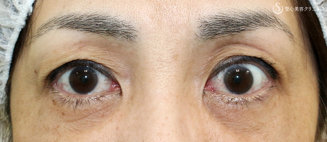 【50代女性・2ヶ月目で修正】切らない眼瞼下垂+α法（術後2ヶ月）札幌院 Before 