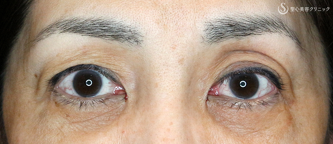 【50代女性・2ヶ月目で修正】切らない眼瞼下垂+α法（術後2ヶ月）札幌院 Before 