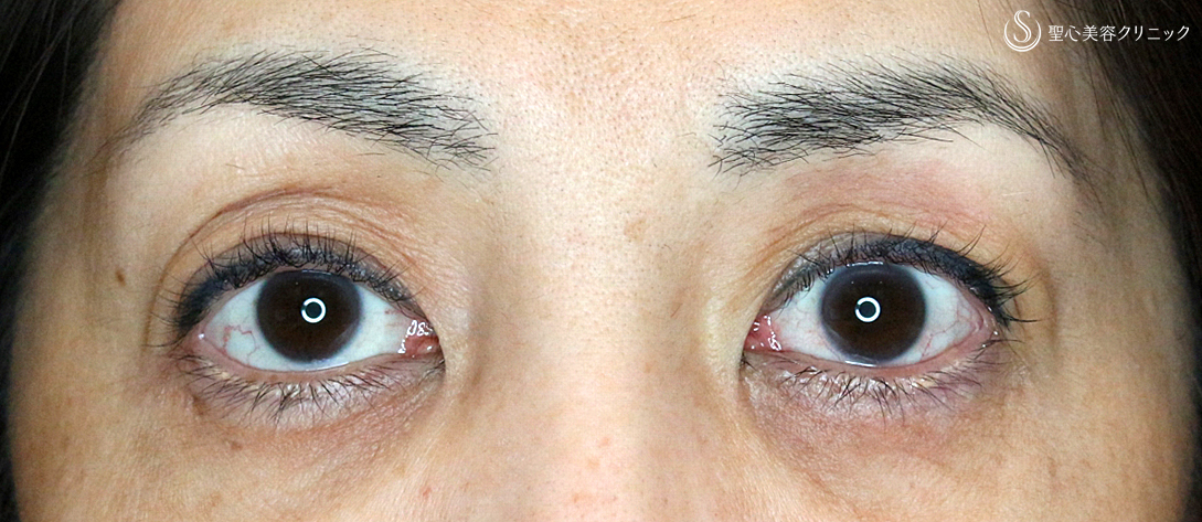 【50代女性・2ヶ月目で修正】切らない眼瞼下垂+α法（術後2ヶ月）札幌院 After 