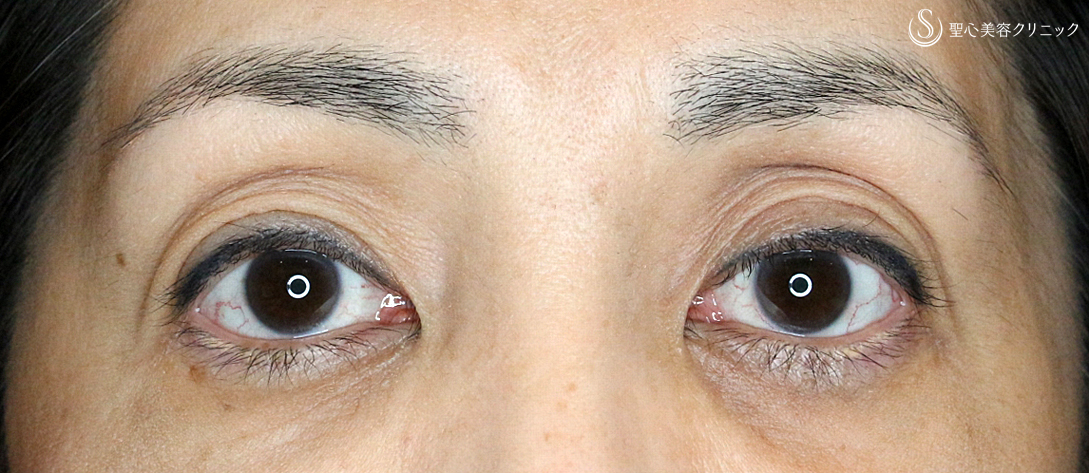 【50代女性・2ヶ月目で修正】切らない眼瞼下垂+α法（術後2ヶ月）札幌院 After 