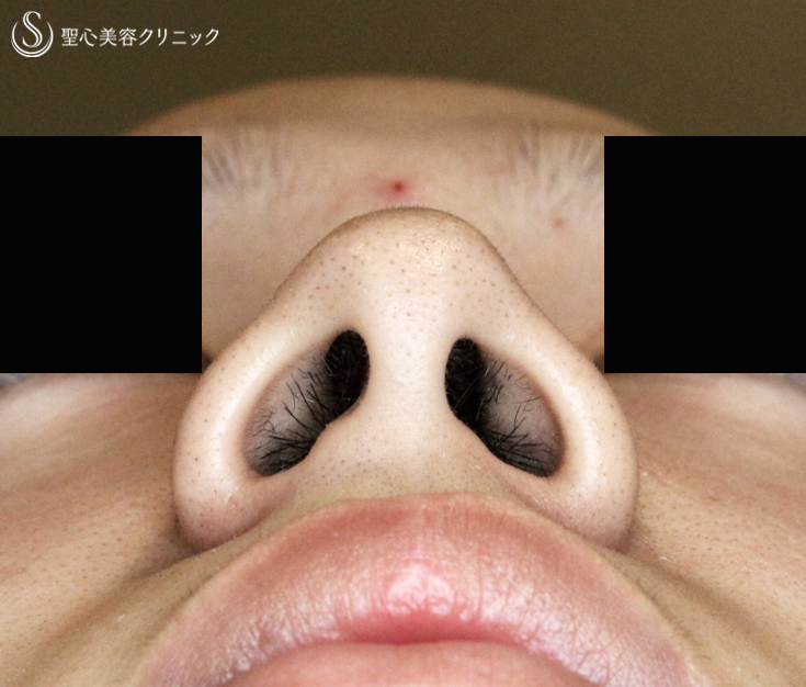 【20代男性・さらにイケメン】小鼻縮小術+α法（1.5ヶ月後）札幌院 Before 