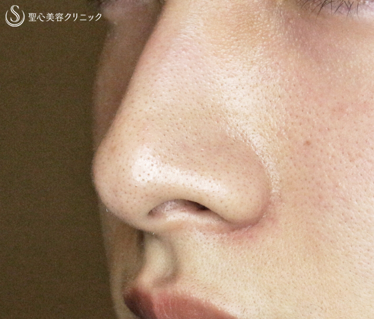 【20代男性・さらにイケメン】小鼻縮小術+α法（1.5ヶ月後）札幌院 Before 