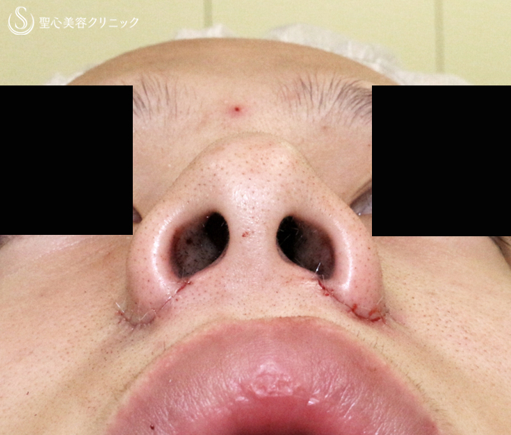【20代男性・さらにイケメン】小鼻縮小術+α法（1.5ヶ月後）札幌院 Before 