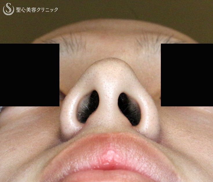 【20代男性・さらにイケメン】小鼻縮小術+α法（1.5ヶ月後）札幌院 After 