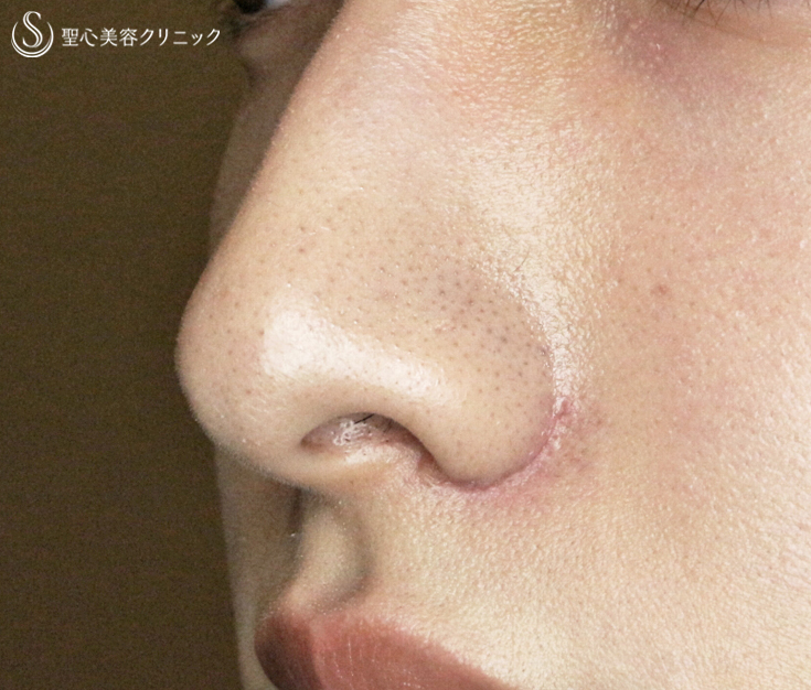 【20代男性・さらにイケメン】小鼻縮小術+α法（1.5ヶ月後）札幌院 After 