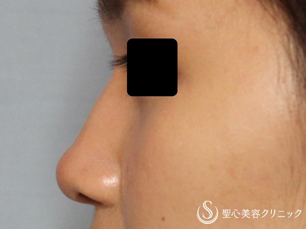 【20代女性・鼻筋を綺麗に】鼻のプロテーゼ（6ヶ月後） Before 