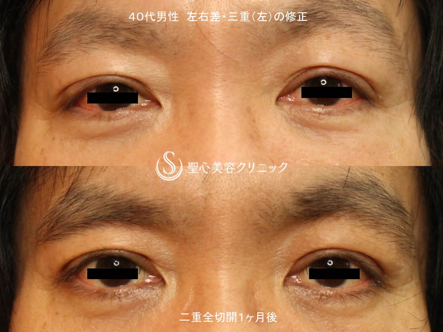 40代男性 三重の改善 二重全切開手術 1 5ヶ月後 症例写真 美容整形 美容外科なら聖心美容クリニック