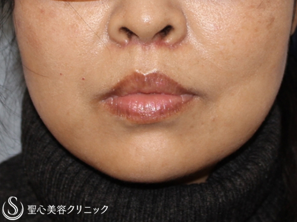 【40代女性・鼻下の長さを改善】リップリフト（1ヶ月後） After 