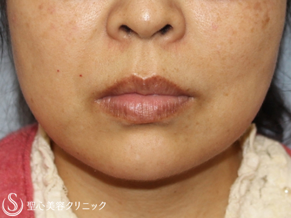 【40代女性・鼻下の長さを改善】リップリフト（1ヶ月後） Before 