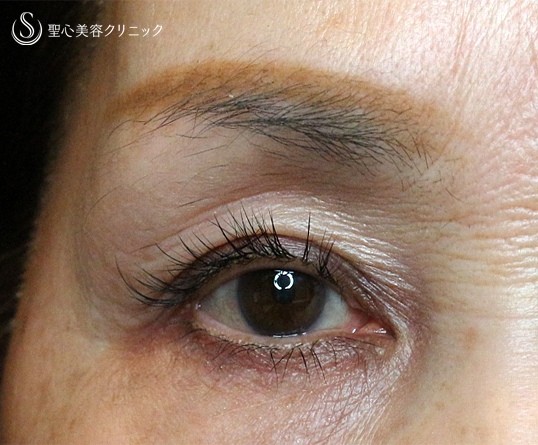 【60代女性・高度な凹み目】プレミアムPRP皮膚再生療法（3年後） After 