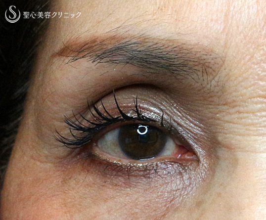 【60代女性・高度な凹み目】プレミアムPRP皮膚再生療法（3年後） Before 