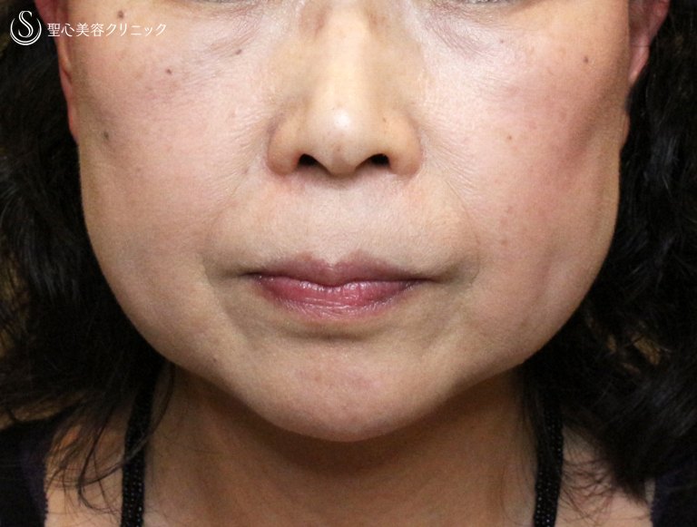 50代女性 小顔 顔ヤセの複合治療 輪郭注射 ウルセラ エラボトックス 6ヶ月後 症例写真 美容整形 美容外科なら聖心美容クリニック
