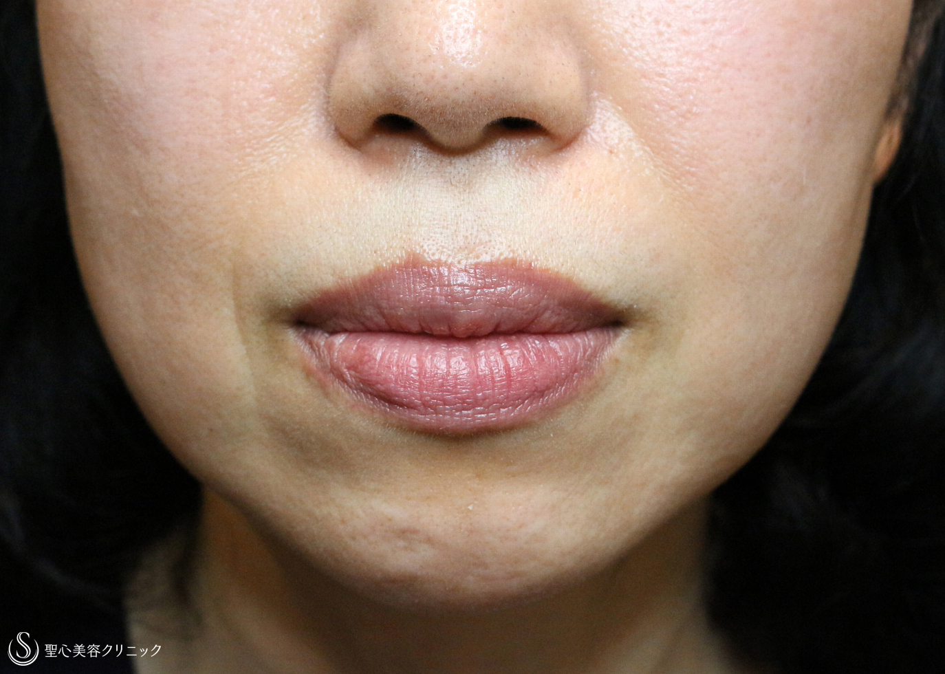 【40代女性・ホウレイ線】プレミアムPRP皮膚再生療法（6ヶ月後） Before 