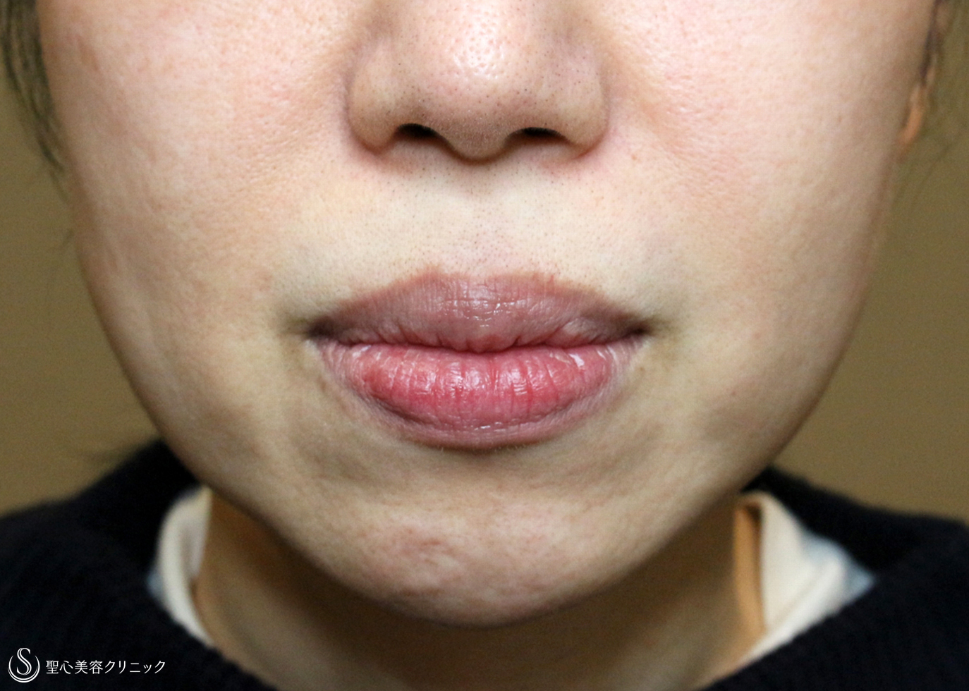 【40代女性・ホウレイ線】プレミアムPRP皮膚再生療法（6ヶ月後） After 