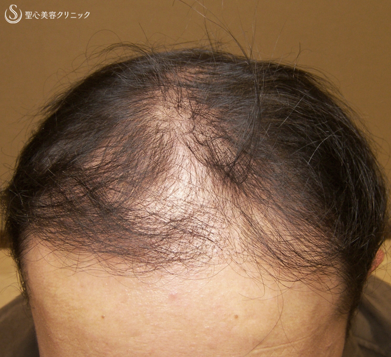 【40代男性・自毛植毛より効果的？】グロースファクター毛髪再生療法（16回処置後） Before 