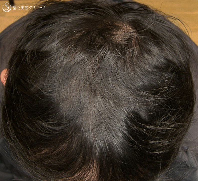 【40代男性・自毛植毛より効果的？】グロースファクター毛髪再生療法（16回処置後） After 