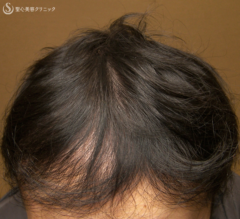 【40代男性・自毛植毛より効果的？】グロースファクター毛髪再生療法（16回処置後） After 