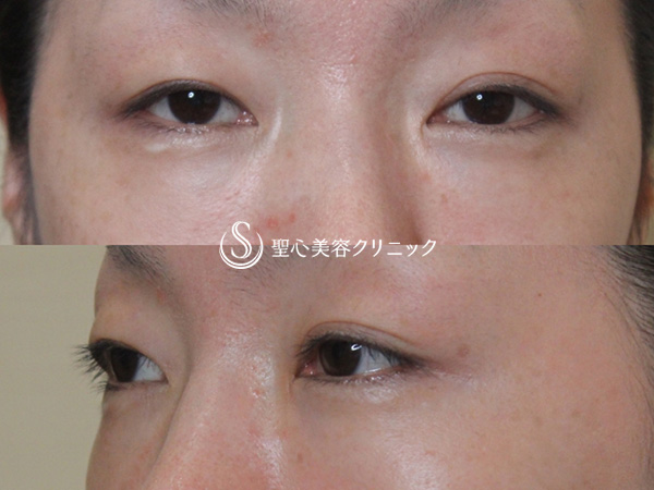 【40代女性・目の上のくぼみ、目の下のくまの改善】プレミアムPRP皮膚再生療法（6ヶ月後） After 
