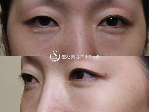 【40代女性・目の上のくぼみ、目の下のくまの改善】プレミアムPRP皮膚再生療法（6ヶ月後） Before 
