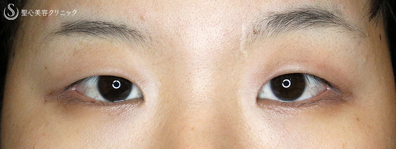 【20代女性・厚い一重による眼瞼下垂】最新の二重全切開+α法（Ver.3）1年後 Before 