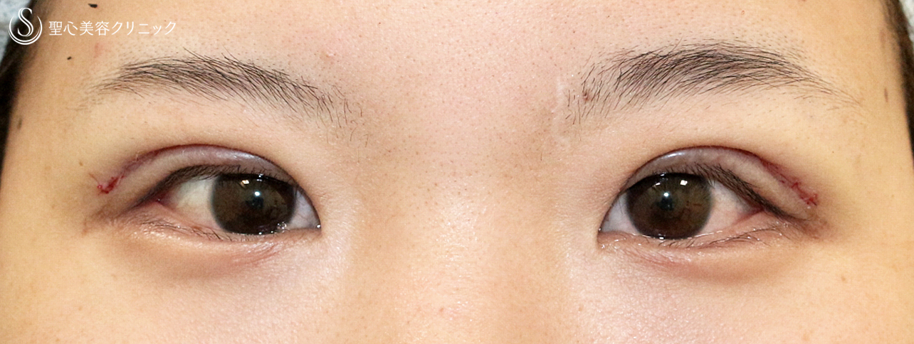 【20代女性・厚い一重による眼瞼下垂】最新の二重全切開+α法（Ver.3）1年後 Before 