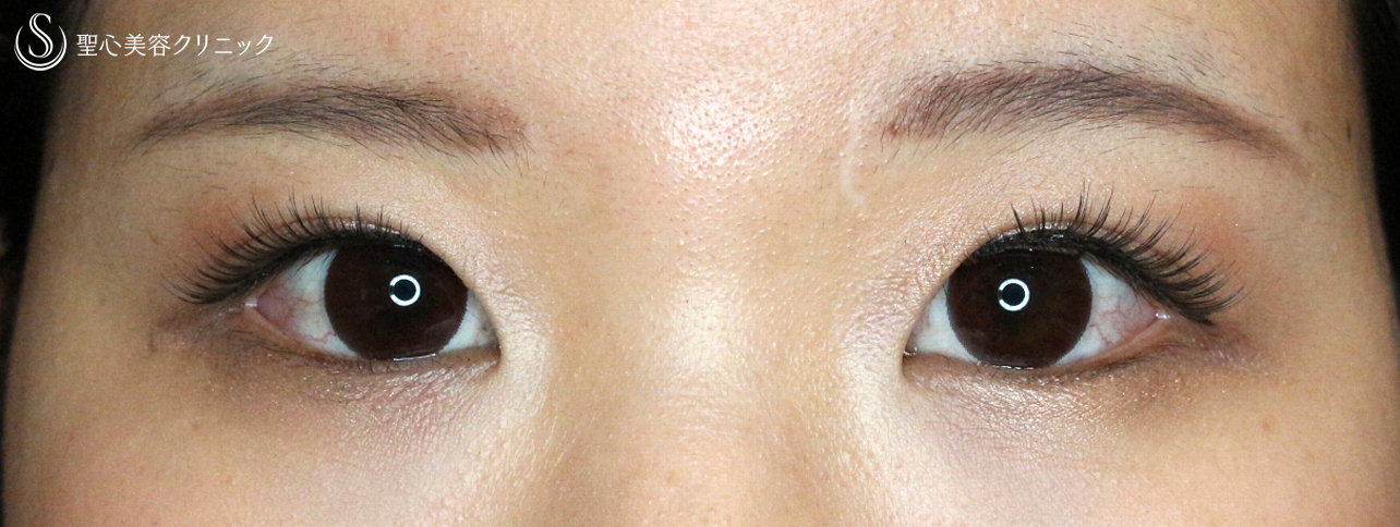 【20代女性・厚い一重による眼瞼下垂】最新の二重全切開+α法（Ver.3）1年後 After 