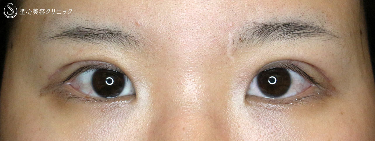 【20代女性・厚い一重による眼瞼下垂】最新の二重全切開+α法（Ver.3）1年後 After 