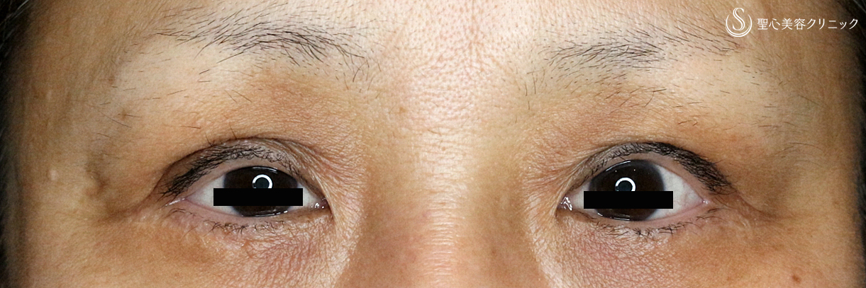 【50代女性・多数回切開後の修正】切らない眼瞼下垂+α法（Ver.2）術直後 Before 