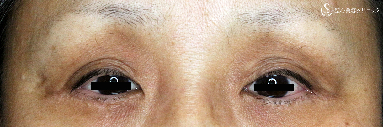 【50代女性・多数回切開後の修正】切らない眼瞼下垂+α法（Ver.2）術直後 Before 