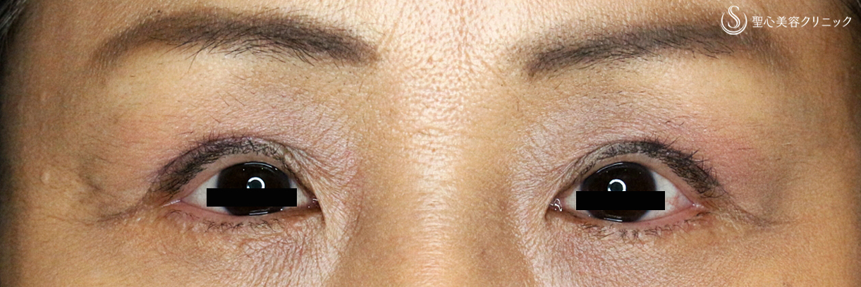 【50代女性・多数回切開後の修正】切らない眼瞼下垂+α法（Ver.2）術直後 After 