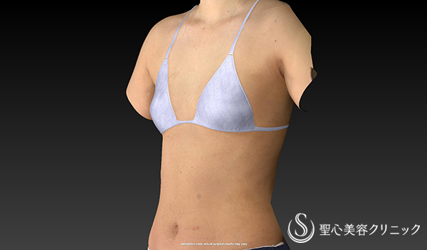 【女性・自分の脂肪でバストアップ】幹細胞豊胸術（セリューション豊胸術） Before 