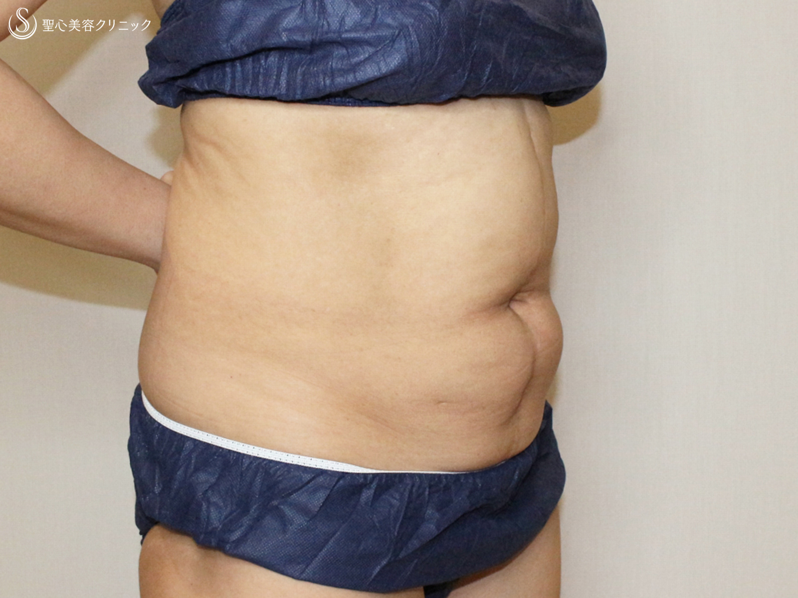 【50代女性・切らないお腹の痩身】リポセルモニター（3ヶ月後） After 