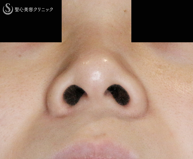 【20代女性・笑顔で広がる小鼻にも 】小鼻縮小術+α法（2ヶ月後） Before 