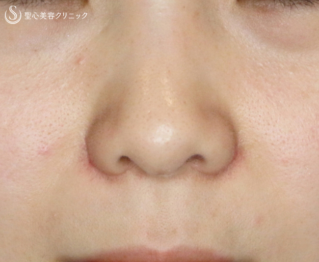【20代女性・笑顔で広がる小鼻にも 】小鼻縮小術+α法（2ヶ月後） After 