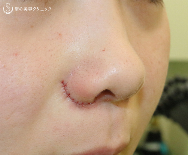 【20代女性・笑顔で広がる小鼻にも 】小鼻縮小術+α法（2ヶ月後） Before 