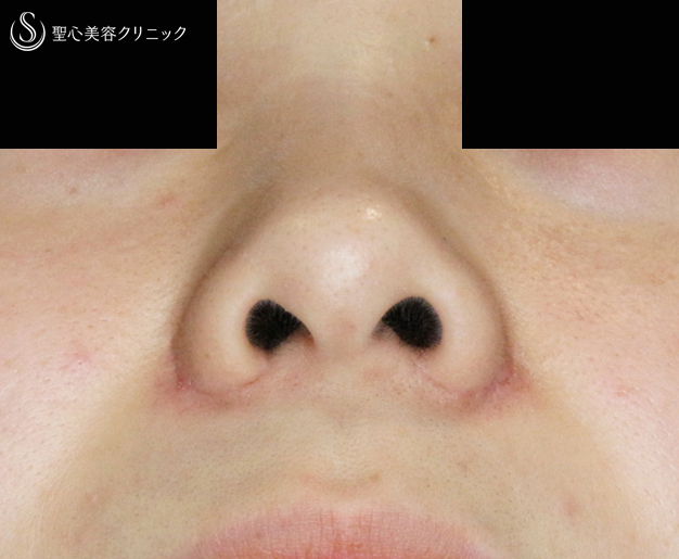 【20代女性・笑顔で広がる小鼻にも 】小鼻縮小術+α法（2ヶ月後） After 