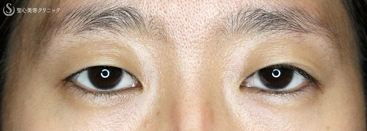 【20代女性・眼瞼下垂＆二重（同時）埋没法】切らない眼瞼下垂+α法（3ヶ月後）札幌院 Before 
