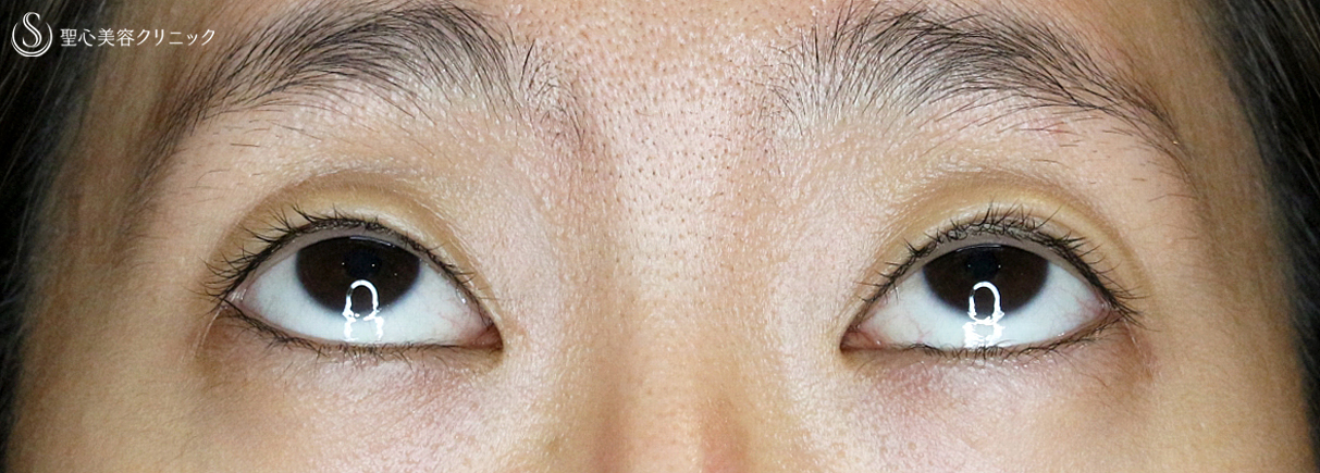 【20代女性・眼瞼下垂＆二重（同時）埋没法】切らない眼瞼下垂+α法（3ヶ月後）札幌院 Before 