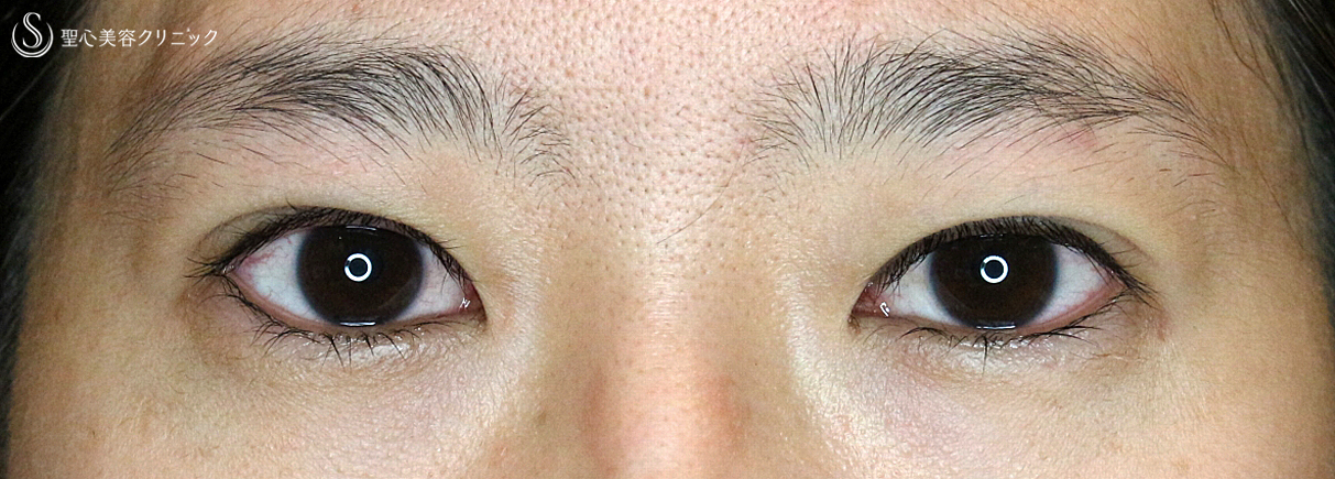 【20代女性・眼瞼下垂＆二重（同時）埋没法】切らない眼瞼下垂+α法（3ヶ月後）札幌院 Before 
