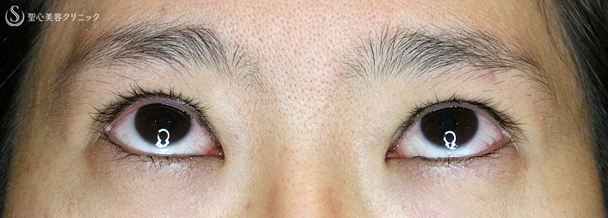 【20代女性・眼瞼下垂＆二重（同時）埋没法】切らない眼瞼下垂+α法（3ヶ月後）札幌院 Before 