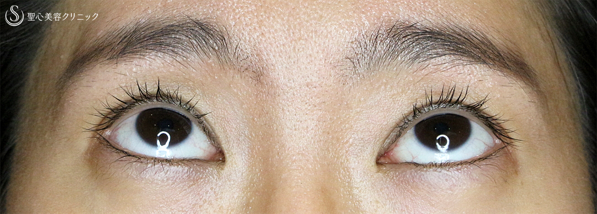 【20代女性・眼瞼下垂＆二重（同時）埋没法】切らない眼瞼下垂+α法（3ヶ月後）札幌院 After 
