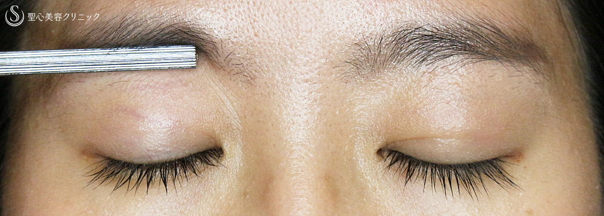 【20代女性・眼瞼下垂＆二重（同時）埋没法】切らない眼瞼下垂+α法（3ヶ月後）札幌院 After 