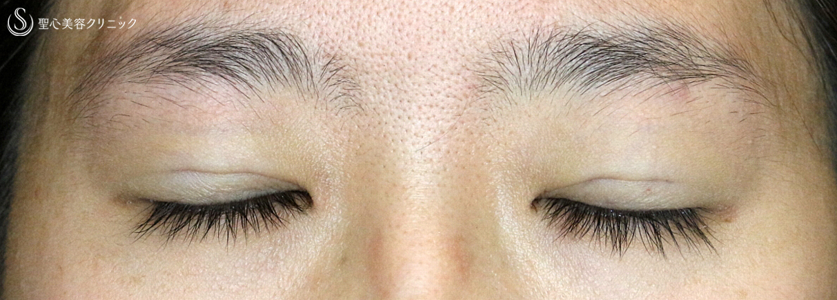 【20代女性・眼瞼下垂＆二重（同時）埋没法】切らない眼瞼下垂+α法（3ヶ月後）札幌院 After 