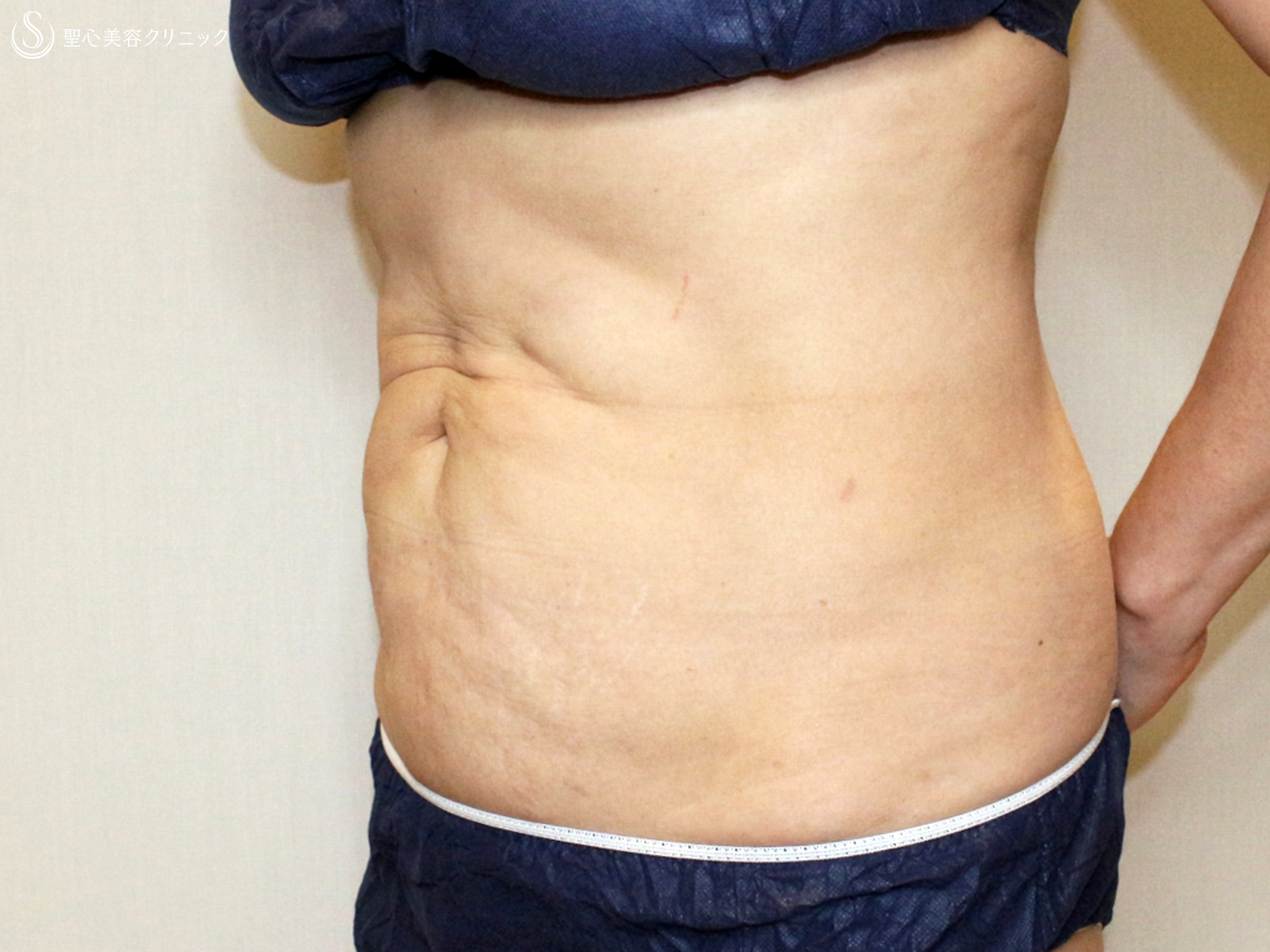 【50代女性・切らないお腹の部分ヤセ&脂肪吸引後の凹凸にも？】リポセルモニター（3ヶ月後） After 