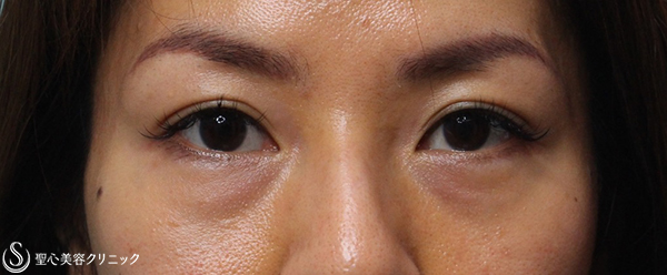 【40代女性・目の下のくま改善】プレミアムPRP（5ヶ月後・2回処置） Before 
