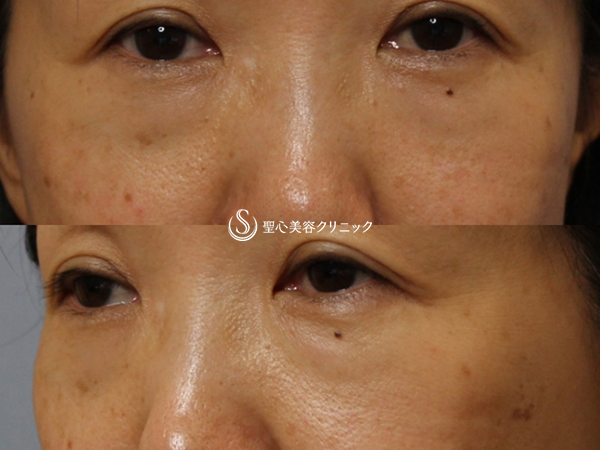 【50代女性・目の下の若返り】プレミアムPRP皮膚再生療法（3ヶ月後） Before 